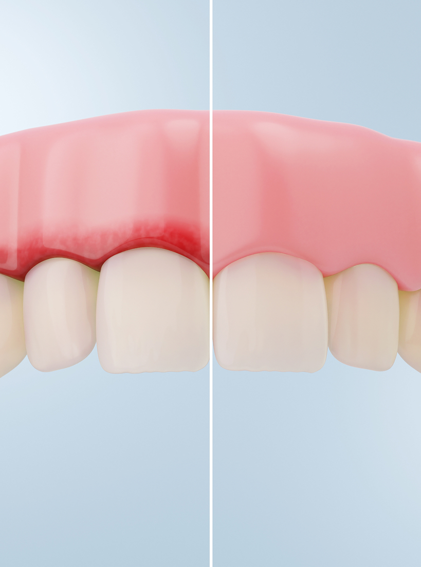 Comment se déroule un traitement des gencives Comment se déroule un traitement des gencives ?