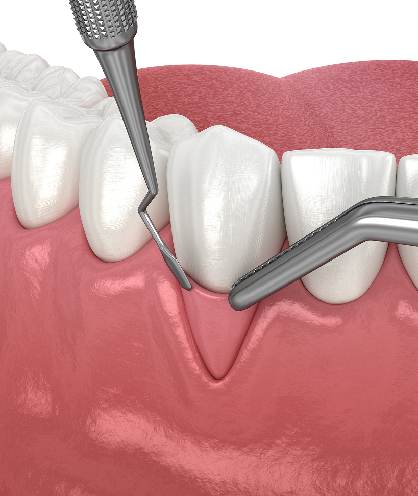 Greffe autogène libre Greffe autogène libre