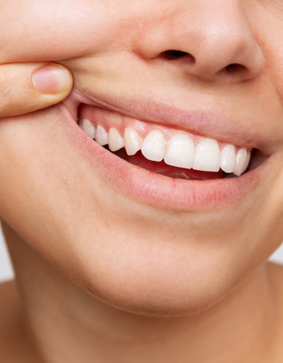 Greffe de gencive à Angus Greffe de gencive à Angus, Montréal: Protéger et renforcer votre sourire