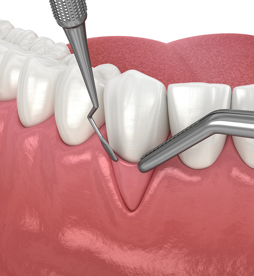 Greffe de gencive Greffe de gencive