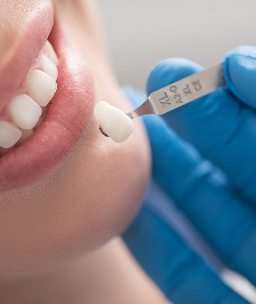 Quelle est la différence entre une couronne et un pont dentaire Quelle est la différence entre une couronne et un pont dentaire ?
La couronne dentaire
La couronne est un « chapeau » de la forme d’une dent qui recouvre entièrement une dent cariée ou endommagée. Le dentiste taille une partie de la dent naturelle pour faire de la place à la couronne, qui est ensuite fixée de façon permanente. Elle permet de protéger la dent, tout en restaurant sa forme, sa couleur et sa fonction d’origine.
Elle peut être fabriquée à partir de différents matériaux esthétiques et résistants comme la céramique ou la porcelaine, lesquels s’harmonisent parfaitement avec le reste de la dentition.
Le pont dentaire
Le pont, aussi appelé « pont fixe » ou « prothèse partielle fixe », est une restauration qui remplace une dent ou une série de plusieurs dents manquantes. Il est composé de couronnes soudées les unes aux autres, et prend appui sur les dents adjacentes à l’espace édenté. Dans certains cas, le pont peut également être fixé sur des implants dentaires pour assurer une meilleure stabilité.